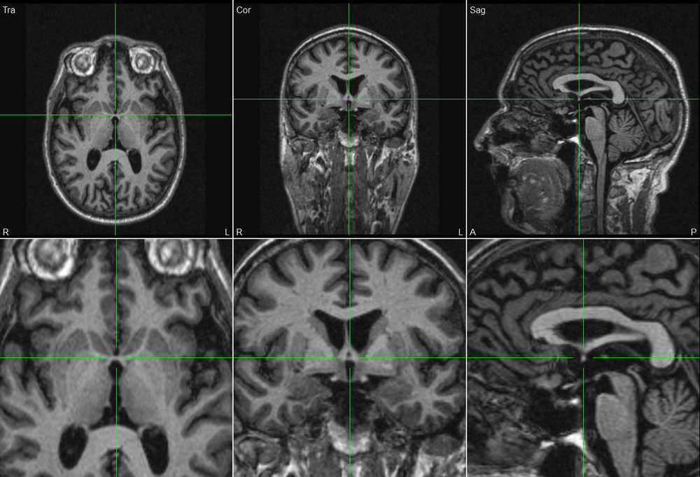 Marking AC-PC Points in BESA MRI - BESA® Wiki