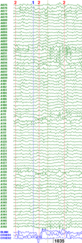 EKG artifacts in MEG data (6).png